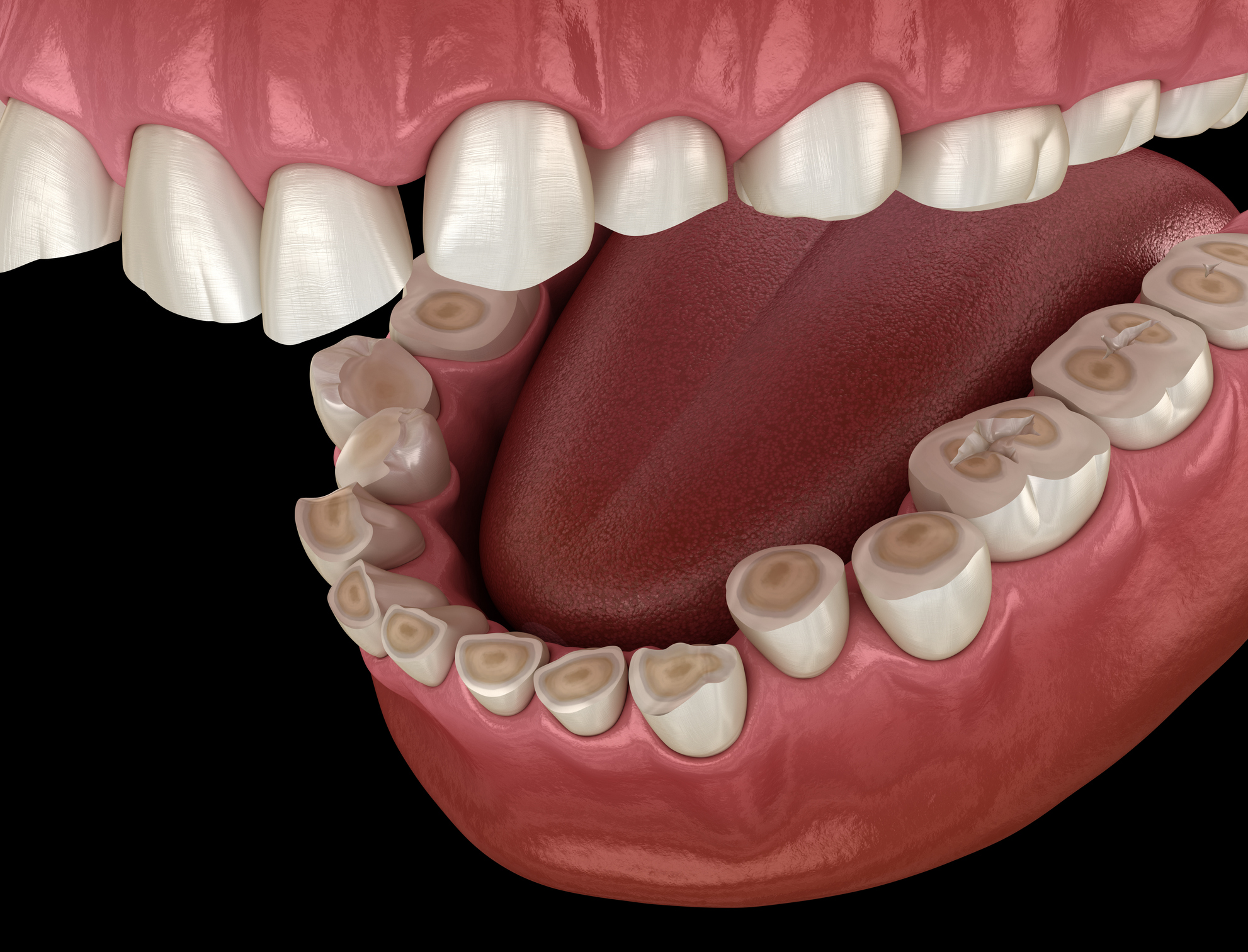 Causes Of Enamel Erosion Dentist In Newbury Park