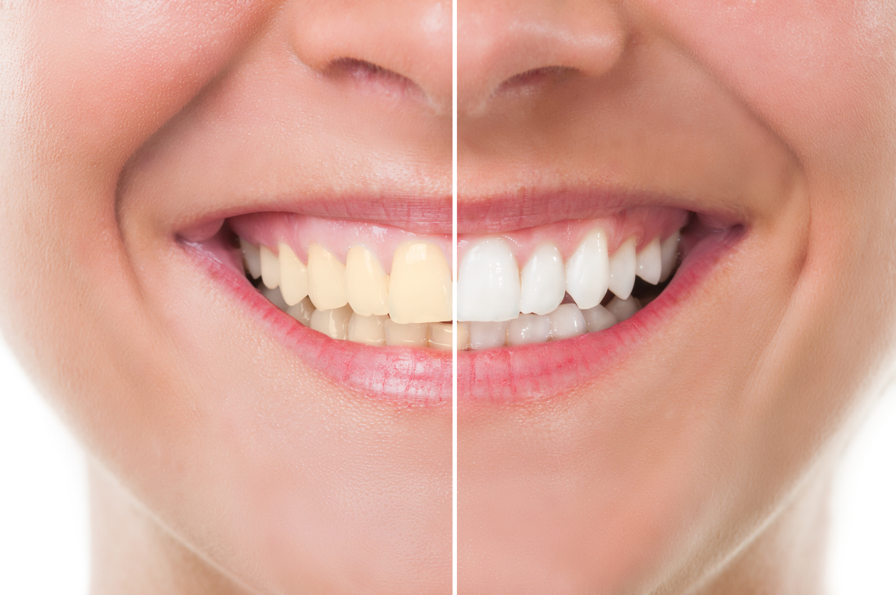 teeth-whitening-dentist-in-newbury-park