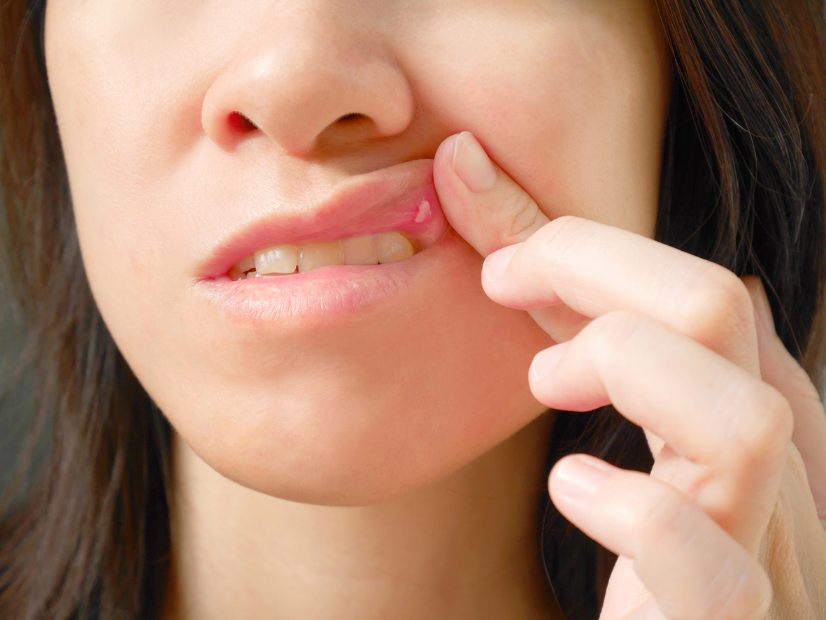 canker-sores-causes-symptoms-treatment-dentist-in-newbury-park