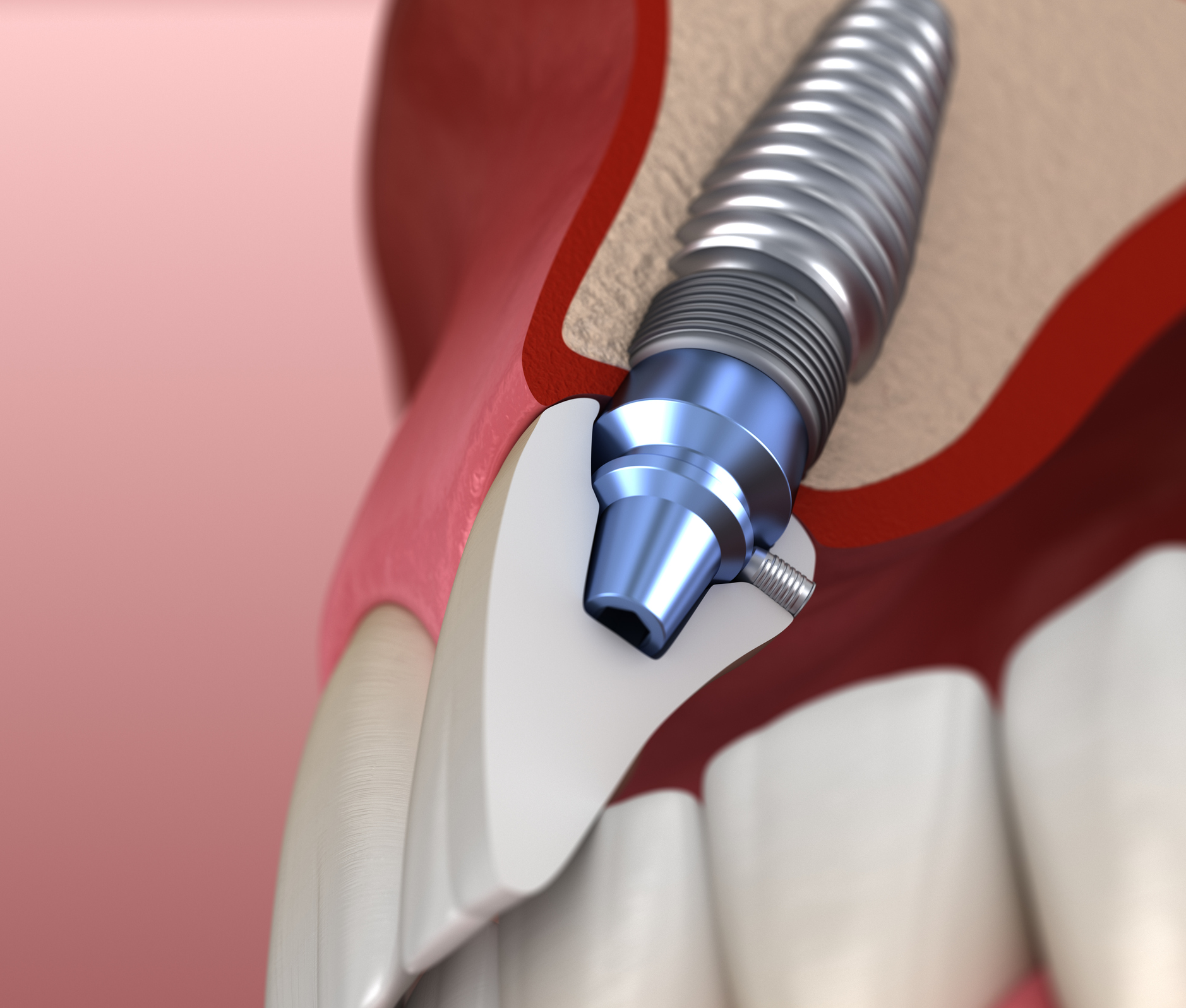 front-tooth-implant-dentist-in-newbury-park